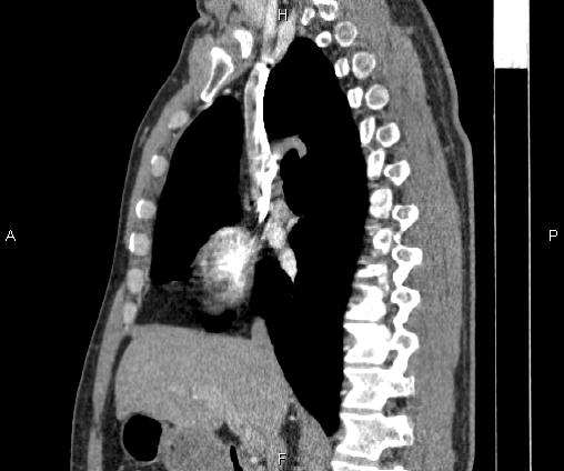 Bilateral pulmonary AVM (Radiopaedia 83134-97505 D 53).jpg