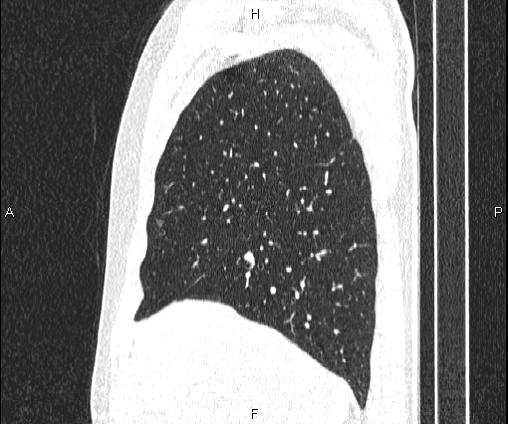 Bilateral pulmonary AVM (Radiopaedia 83134-97505 Sagittal lung window 35).jpg