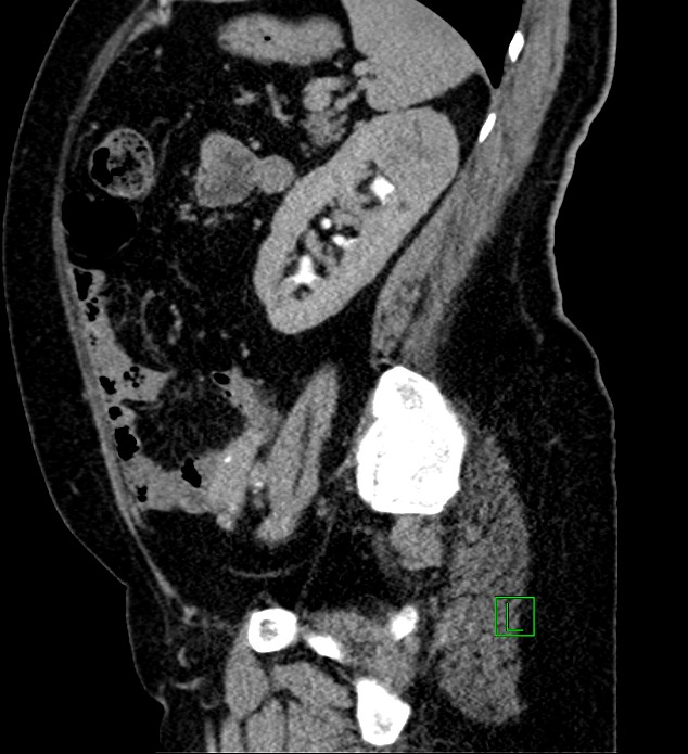 Bilateral sporadic synchronous clear cell renal cell carcinoma (Radiopaedia 85035-100575 J 12).jpg