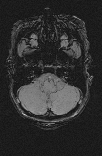 Bilateral subdural hemorrhage and parietal skull fracture (Radiopaedia 26058-26190 Axial SWI 11).png