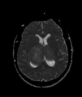 File:Bilateral thalamic gliomata (Radiopaedia 42538-45664 Axial ADC 13).jpg