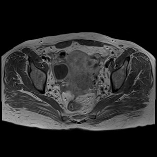 Bilateral tubo-ovarian abscesses (Radiopaedia 58635-65829 Axial T1 C+ 28).jpg