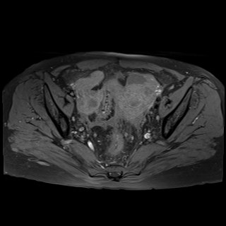 Bilateral tubo-ovarian abscesses (Radiopaedia 58635-65829 Axial T1 fat sat 20).jpg