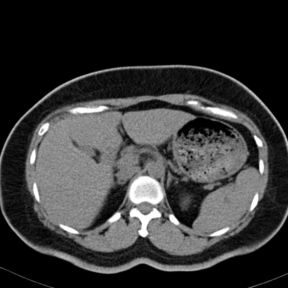 Bilateral ureteric stents (Radiopaedia 48795-53825 Axial non-contrast 13).jpg