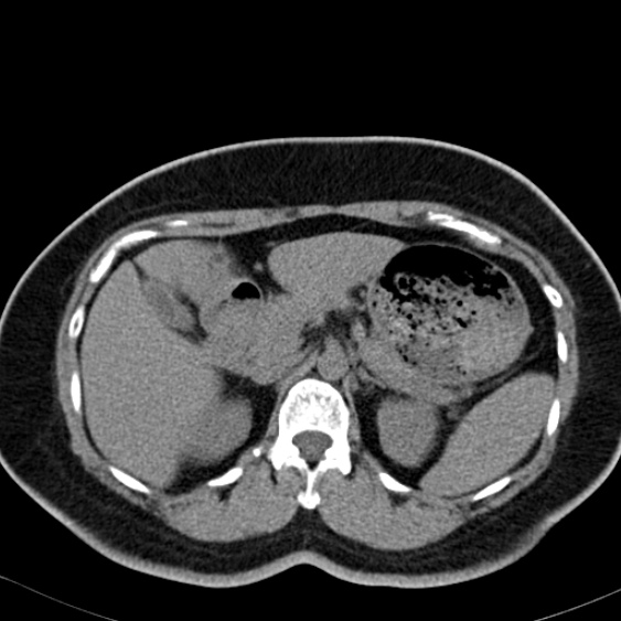 Bilateral ureteric stents (Radiopaedia 48795-53825 Axial non-contrast 15).jpg