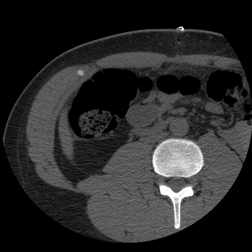 File:Bile leak from liver traumatic laceration (Radiopaedia 63463-72077 Axial Biliscopin 82).jpg