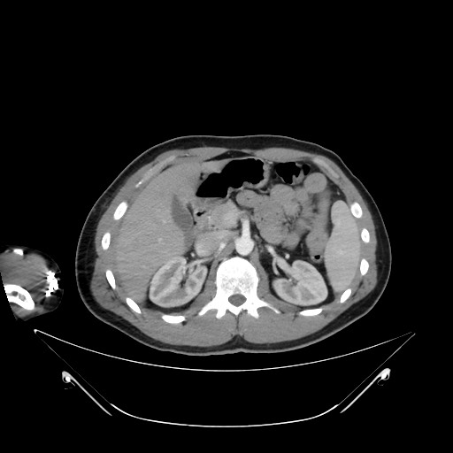 Bile leak from liver traumatic laceration (Radiopaedia 63463-72078 A 24).jpg
