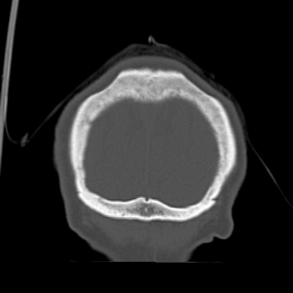 Biparietal osteodystrophy (Radiopaedia 46109-50463 Coronal bone window 97).jpg