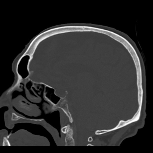 Biparietal osteodystrophy (Radiopaedia 46109-50463 Sagittal bone window 56).jpg