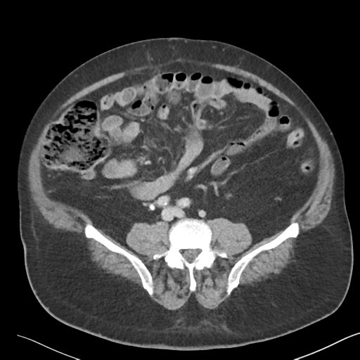 File:Bladder papillary urothelial carcinoma (Radiopaedia 48119-52951 Axial 34).png