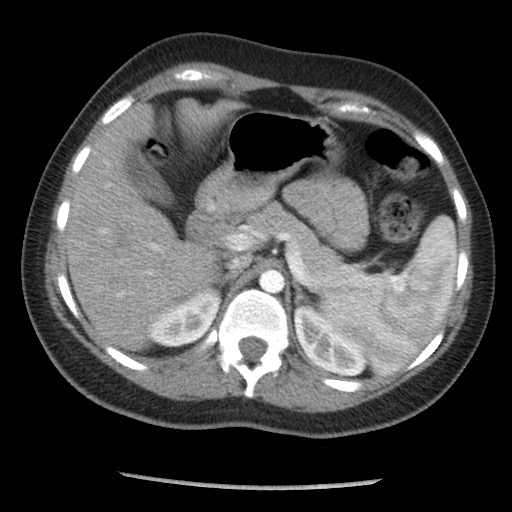 File:Borderline mucinous tumor (ovary) (Radiopaedia 78228-90808 A 47).jpg