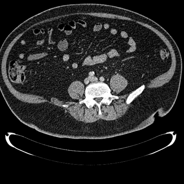 Bosniak renal cyst - type IV (Radiopaedia 24244-24518 C 253).jpg