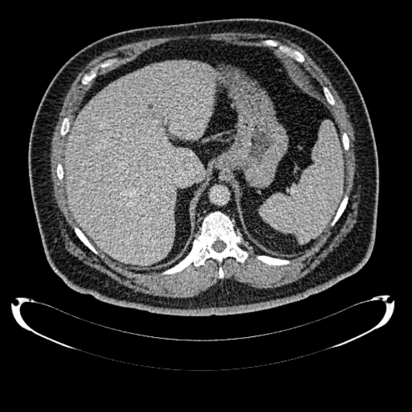 Bosniak renal cyst - type IV (Radiopaedia 24244-24518 C 57).jpg
