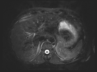 File:Bouveret syndrome (Radiopaedia 61017-68856 Axial MRCP 13).jpg