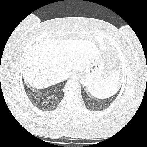 Bovine aortic arch - right internal mammary vein drains into the superior vena cava (Radiopaedia 63296-71875 Axial lung window 138).jpg