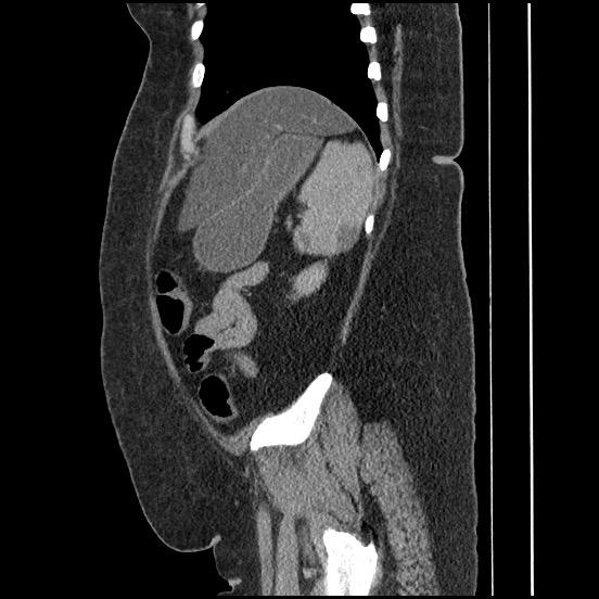 Bowel and splenic infarcts in acute lymphocytic leukemia (Radiopaedia 61055-68913 C 23).jpg