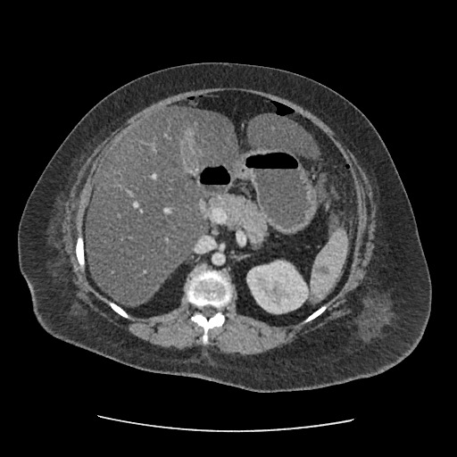 File:Bowel and splenic infarcts in acute lymphocytic leukemia (Radiopaedia 61055-68915 A 53).jpg
