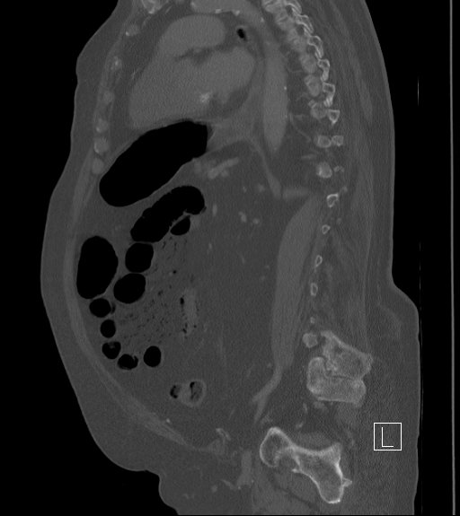 Bowel ischemia secondary to SMA occlusion with extensive portomesenteric venous gas (Radiopaedia 54656-60871 Sagittal bone window 42).jpg