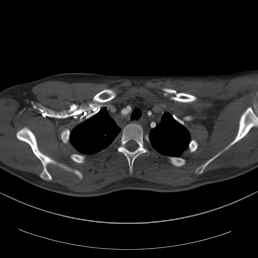 Brachiocephalic trunk pseudoaneurysm (Radiopaedia 70978-81191 Axial bone window 51).jpg