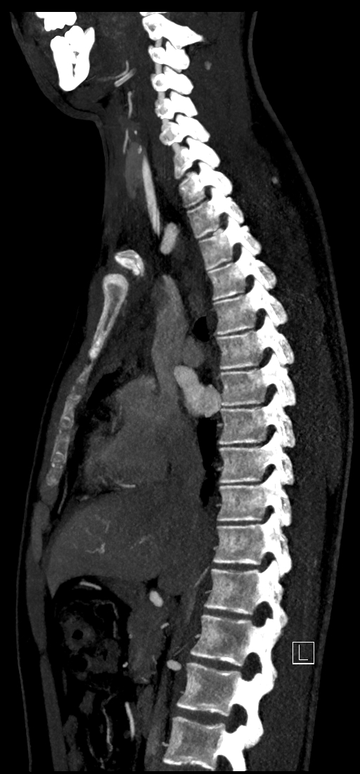 Brachiocephalic trunk pseudoaneurysm (Radiopaedia 70978-81191 C 44).jpg