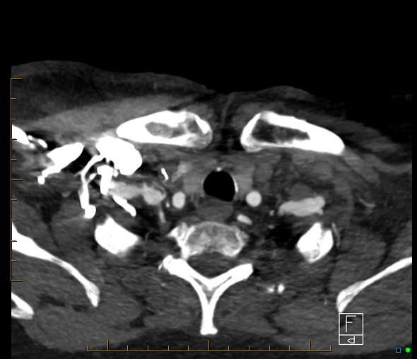 Brachiocephalic trunk stenosis (Radiopaedia 87242-103519 A 123).jpg