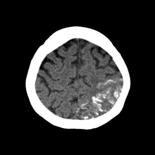 Brain cortical laminar necrosis (Radiopaedia 25822-25971 Axial non-contrast 37).jpg