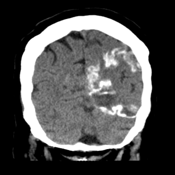 Brain cortical laminar necrosis (Radiopaedia 25822-25971 C 44).jpg