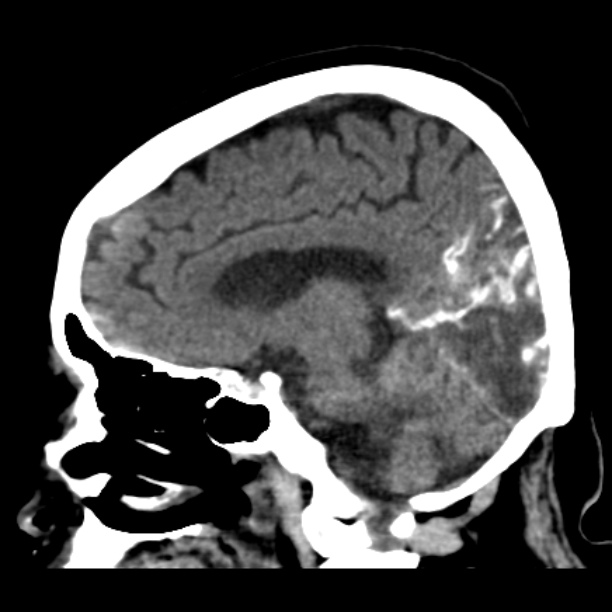 Brain cortical laminar necrosis (Radiopaedia 25822-25971 non-contrast 29).jpg