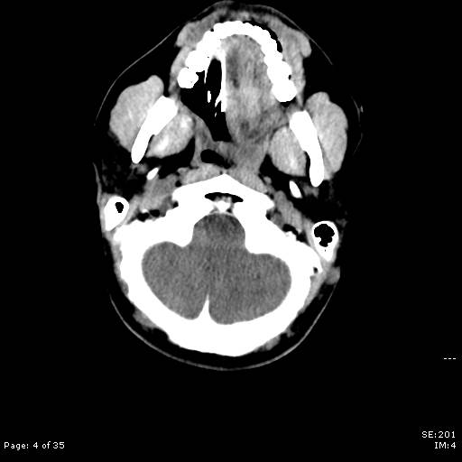 File:Brain death after motor vehicle collision (Radiopaedia 88470-105114 Axial non-contrast 4).jpg