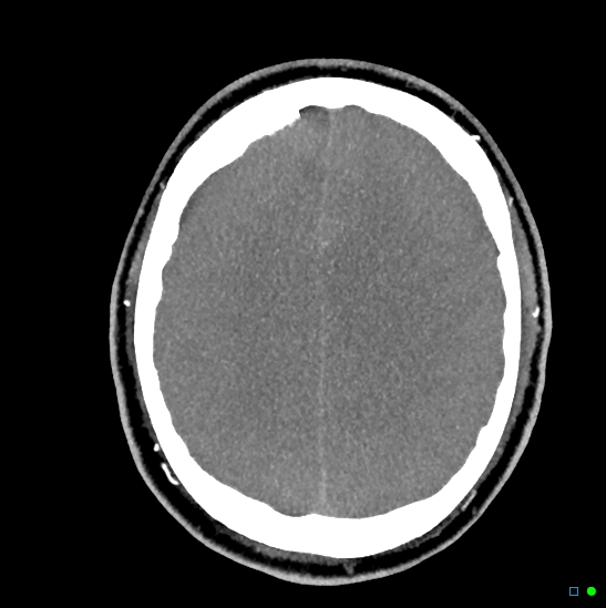 File:Brain death on MRI and CT angiography (Radiopaedia 42560-45841 B 18).jpg