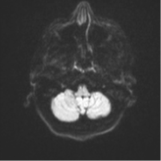 Brain metastasis (sarcoma) (Radiopaedia 47576-52209 Axial DWI 33).png