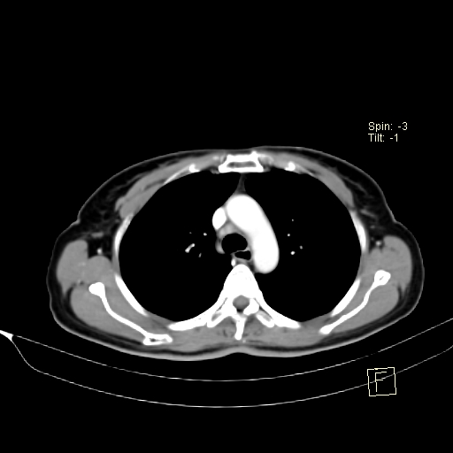 Brain metastasis as initial presentation of non-small cell lung cancer (Radiopaedia 65122-74127 A 16).jpg