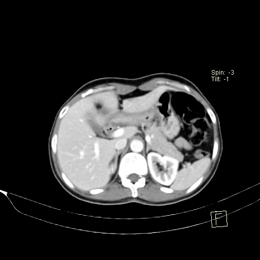 Brain metastasis as initial presentation of non-small cell lung cancer (Radiopaedia 65122-74127 A 50).jpg