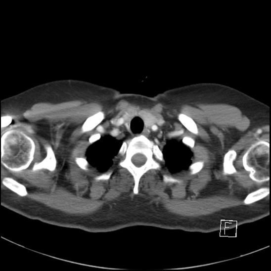 File:Breast metastases from renal cell cancer (Radiopaedia 79220-92225 A 9).jpg