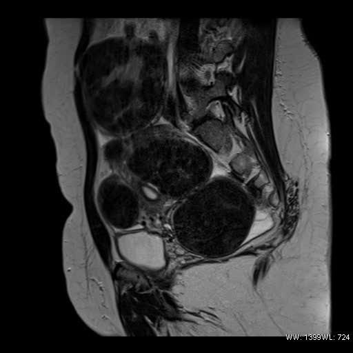 File:Broad ligament fibroid (Radiopaedia 49135-54241 Sagittal T2 10).jpg