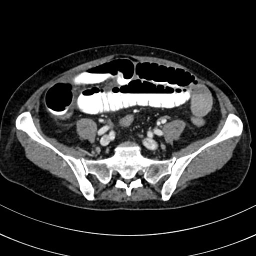 File:Broad ligament hernia (Radiopaedia 84802-100276 A 63).jpg