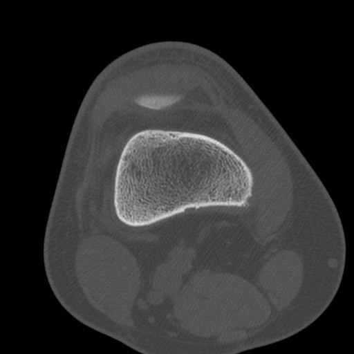 Brodie abscess of the tibia (Radiopaedia 58984-66250 Axial bone window 16).jpg