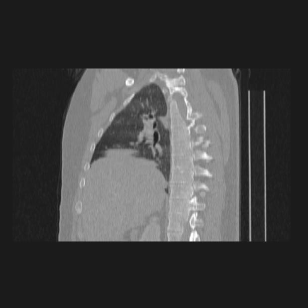 Bronchial atresia (Radiopaedia 60685-68439 Sagittal lung window 32).jpg