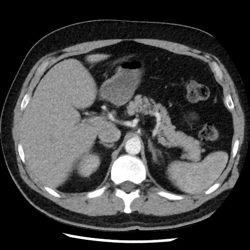 Bronchial carcinoid tumor (Radiopaedia 67377-76764 A 63).jpg