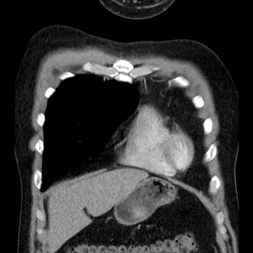File:Bronchial carcinoid tumor (Radiopaedia 67377-76764 C 21).jpg