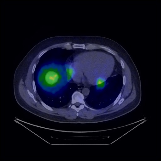 File:Bronchial carcinoid tumor (Radiopaedia 67377-76765 68Ga-DOTATATE PET-CT 36).jpg