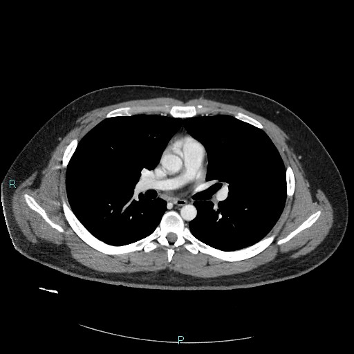 Bronchial carcinoid tumor (Radiopaedia 78272-90875 A 48).jpg