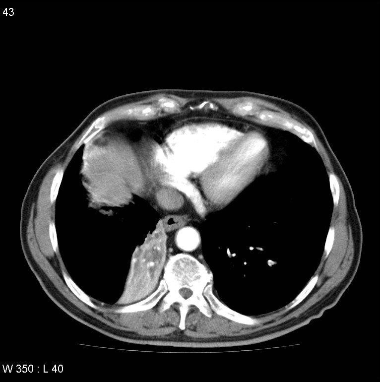 Bronchial carcinoid tumor with right lower lobe collapse (Radiopaedia 29060-29422 A 42).jpg