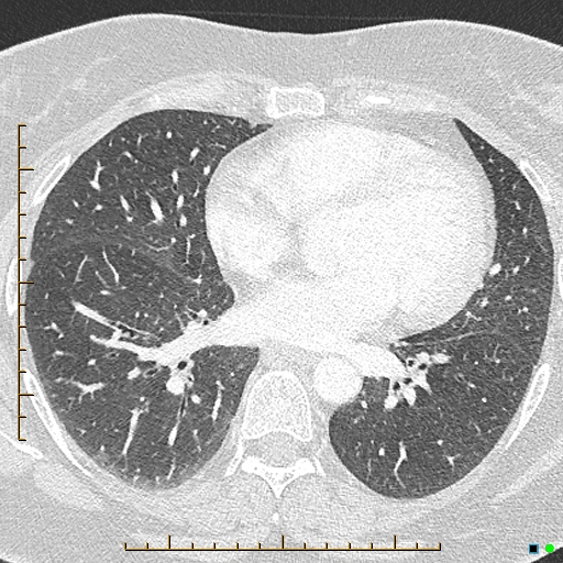 Bronchial diverticula (Radiopaedia 79512-92676 Axial lung window 119).jpg