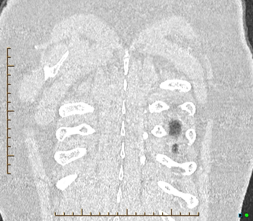 Bronchial diverticula (Radiopaedia 79512-92676 B 180).jpg