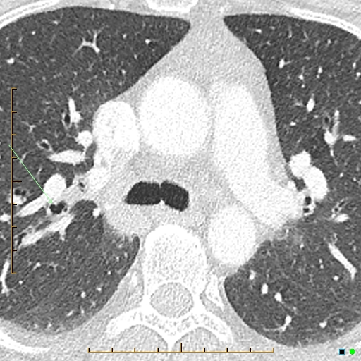 File:Bronchial diverticula (Radiopaedia 79512-92677 Axial lung window 4).jpg