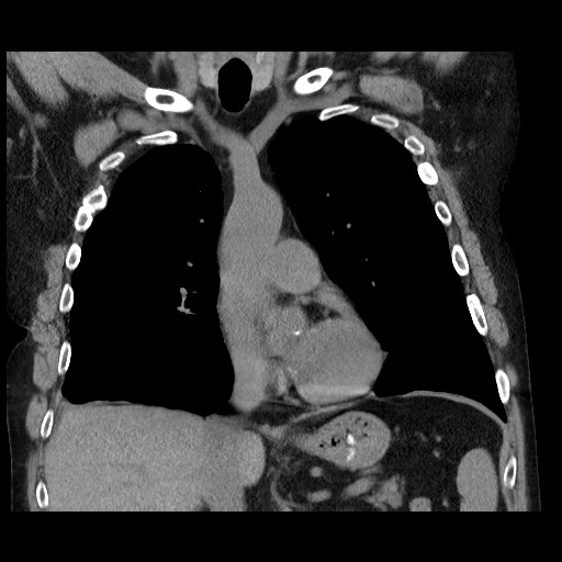 Bronchial stenosis - lung transplant (Radiopaedia 73133-83848 Coronal non-contrast 31).jpg