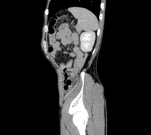 Bronchiectasis in Crohn disease (Radiopaedia 60311-67977 D 99).jpg