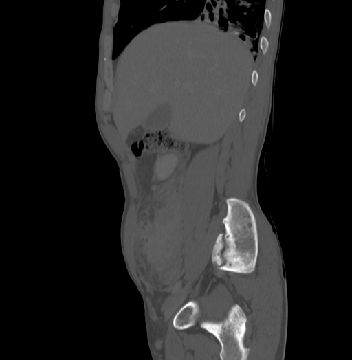 Bronchiectasis in Crohn disease (Radiopaedia 60311-67977 Sagittal bone window 55).jpg
