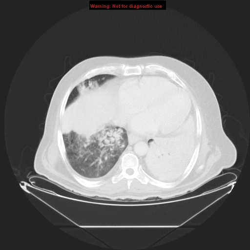 File:Bronchioloalveolar carcinoma (Radiopaedia 9272-9955 Axial lung window 22).jpg